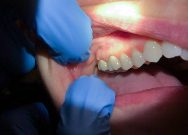 Best Chipped Tooth Repair Near Me  in Elsberry, MO